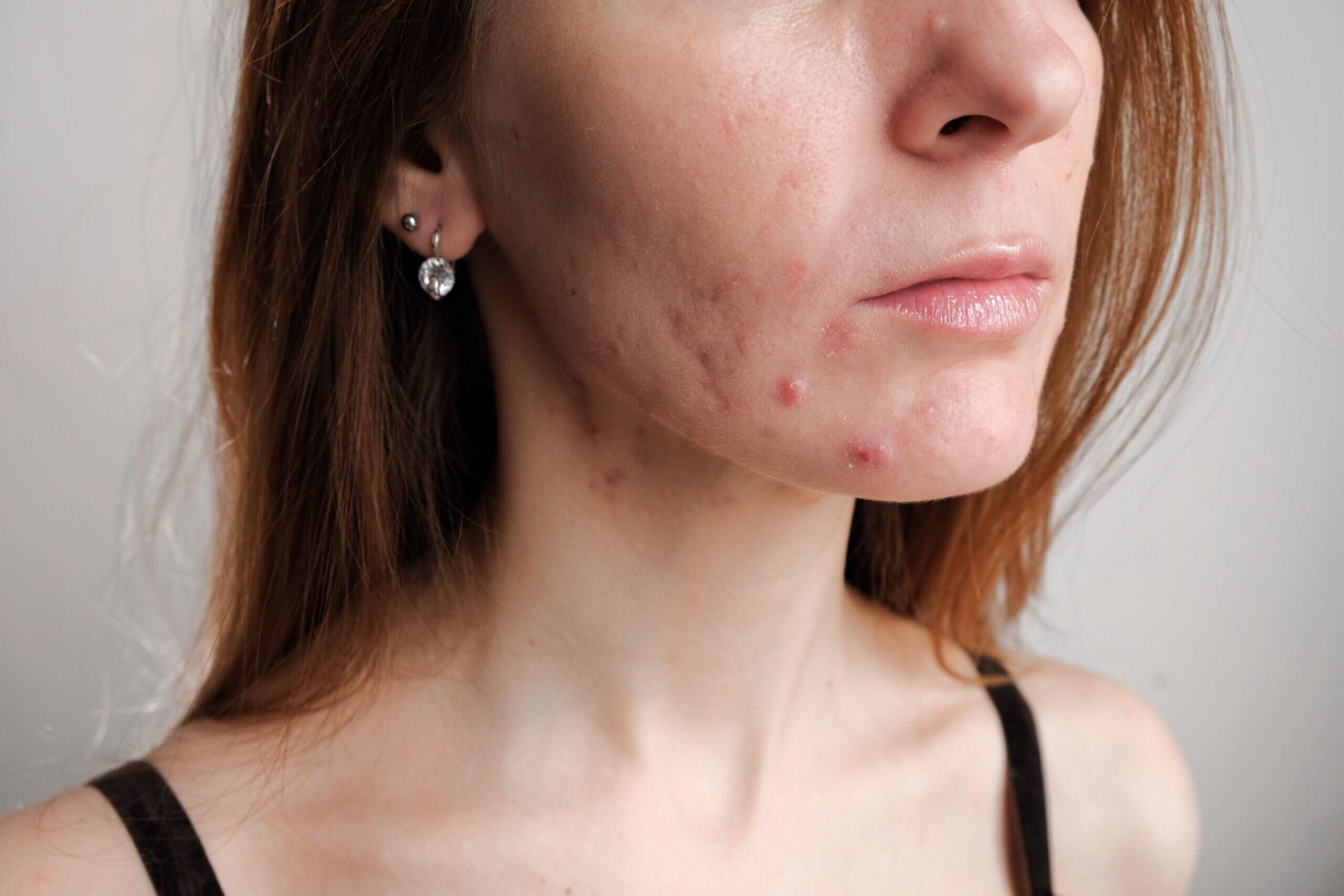 Best herbs for hormonal acne