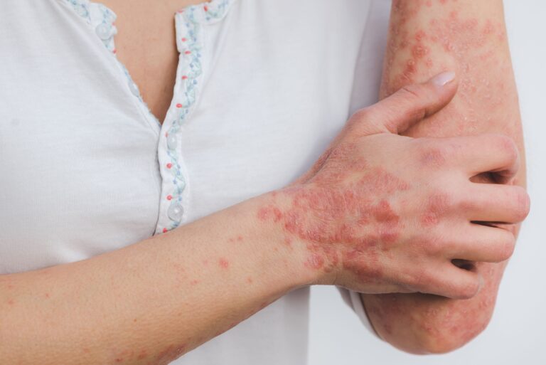 Treatment for Psoriasis: Amazing Relief for Itchy, Scaly Skin