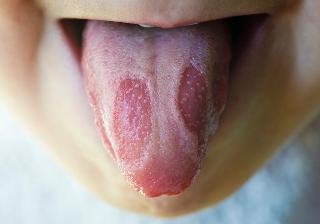 Home Remedies for Geographic Tongue